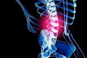 腰椎骨软骨病